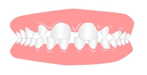 انوع ناهنجاری های دندانی